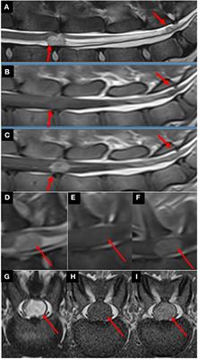 Clinical, magnetic resonance imaging, and histological description of a choroid plexus papilloma with disseminated intraventricular and spinal cerebrospinal fluid drop metastases in a young adult dog: a case report